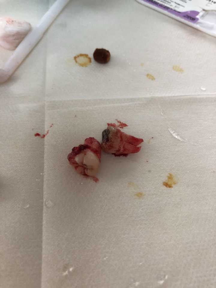 拔智齿是种怎样的体验