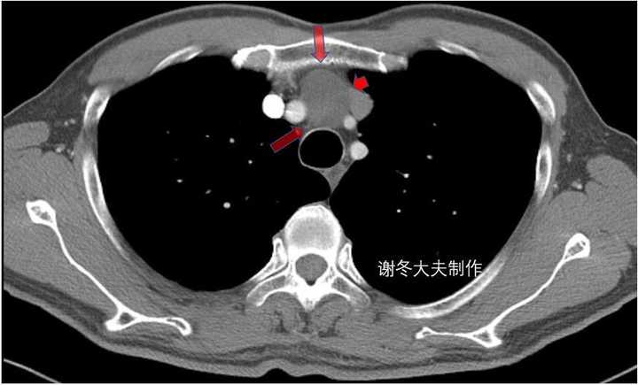 增强ct是否能判断胸腺瘤是良性还是恶性的?