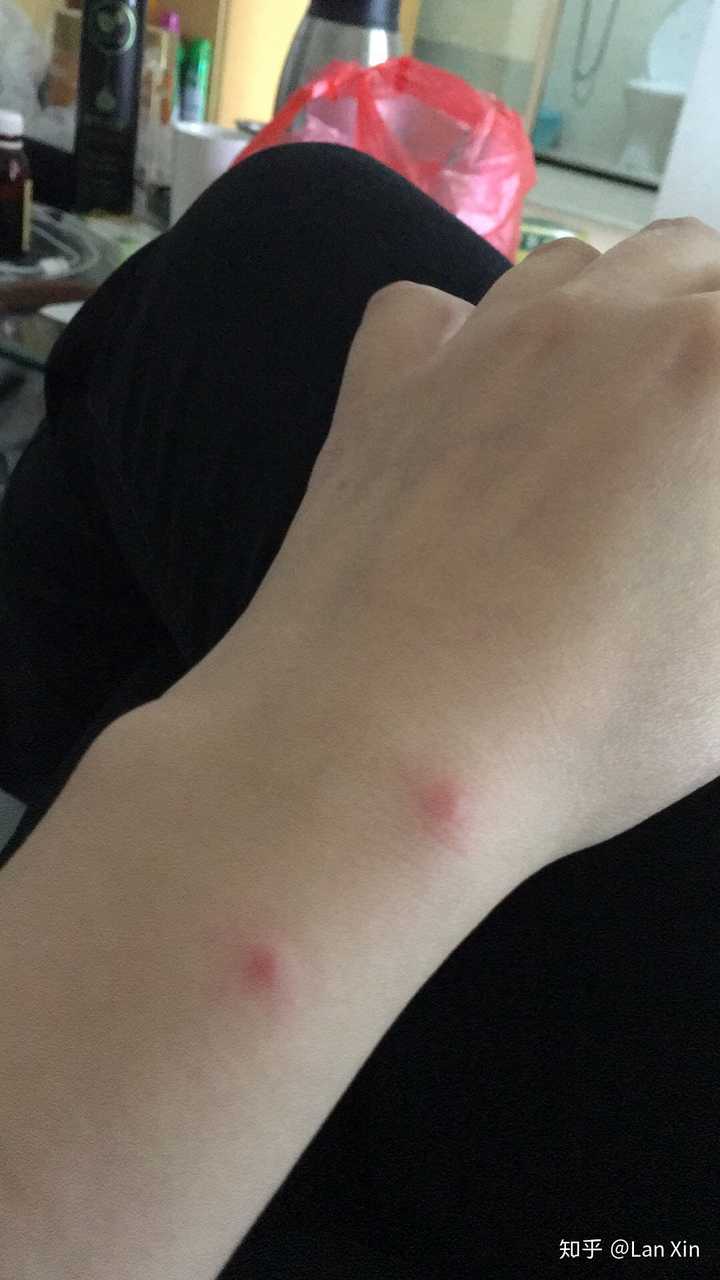 被跳蚤咬的全身都是包是什么样的感受