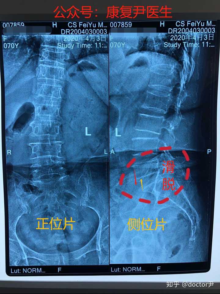 1) 腰椎间盘突出症的x光影像