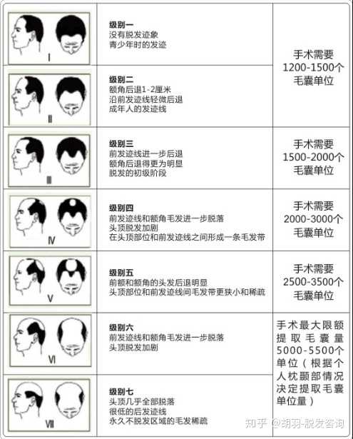 女士的脱发等级图可以自行网上查询下.