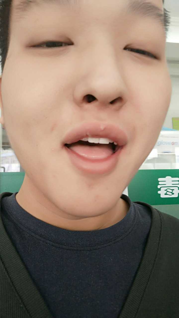 可以看出我的口腔比较小,其他牙齿已经被智齿挤得很密(还拔掉一颗挤