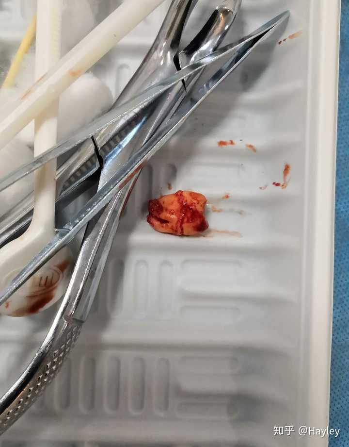 拔智齿和拔完智齿是怎样一种体验?