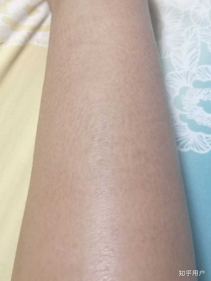 鱼鳞病还有未来吗?