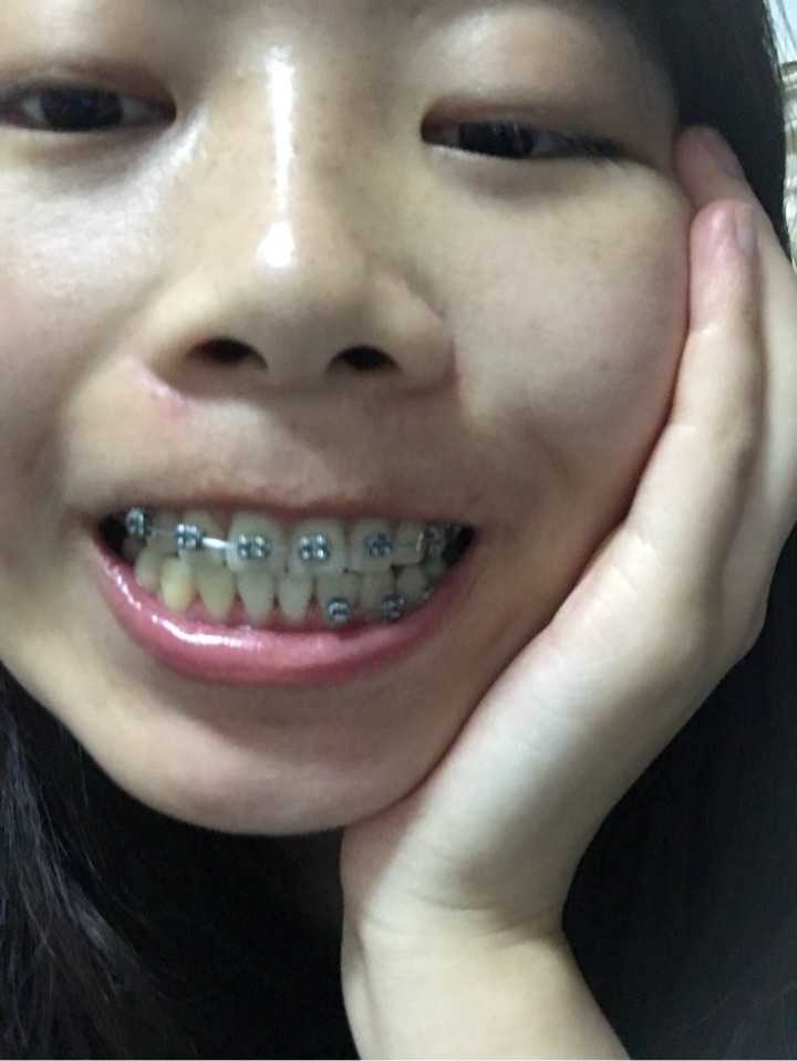 25 岁后去矫正牙齿(戴牙套)是什么体验?