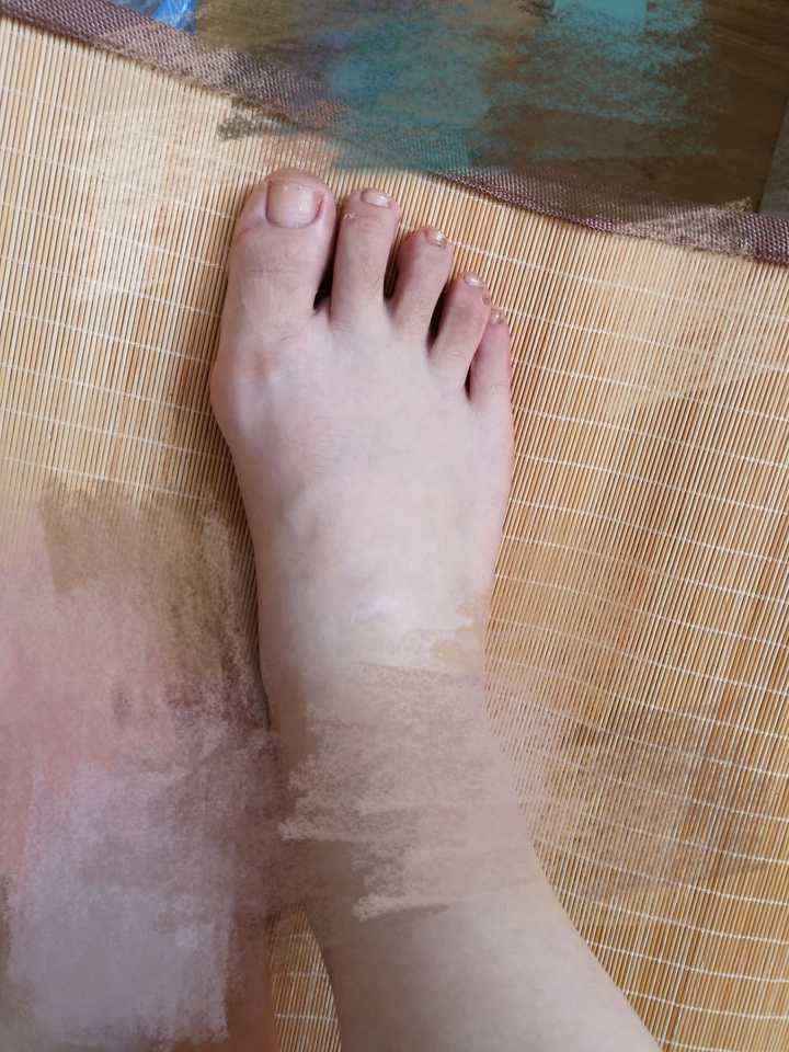 作为一个女生,脚拇指外翻是一种怎样的体验?