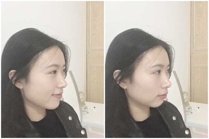 下巴后缩怎么办?
