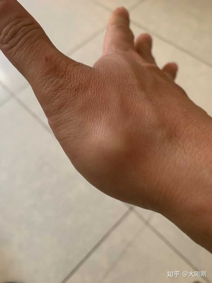 手背与胳膊之间的筋脉上面起了一个小疙瘩那是怎么回事儿?