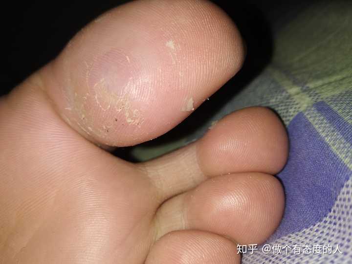 跖疣和鸡眼有什么区别,医学上有没有什么治疗跖疣的好