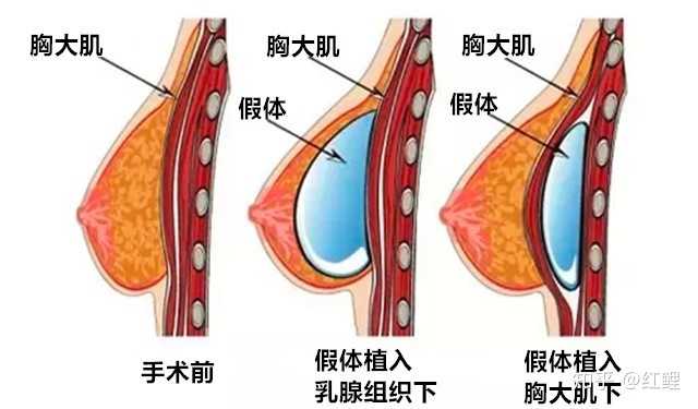 隆胸大概要多少钱?假体隆胸手术多少钱?