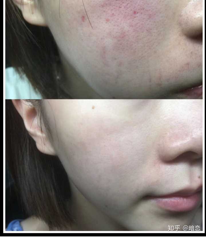 痘痘肌肤用什么洗面奶比较好?