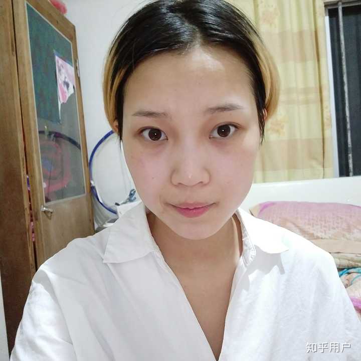 割双眼皮失败是什么样子的