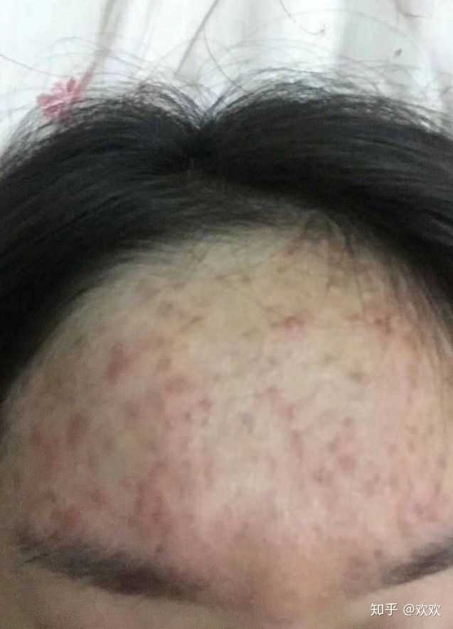 我之前也长了很多痘痘,准确来说用了九个月终于是把这该死的痘痘给