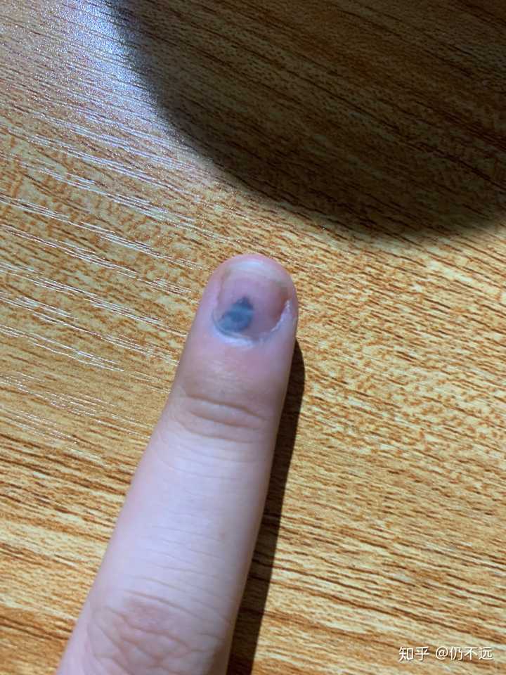 手指被门夹了然后指甲里面四分之一有淤血都两个月了还没好怎么办求助