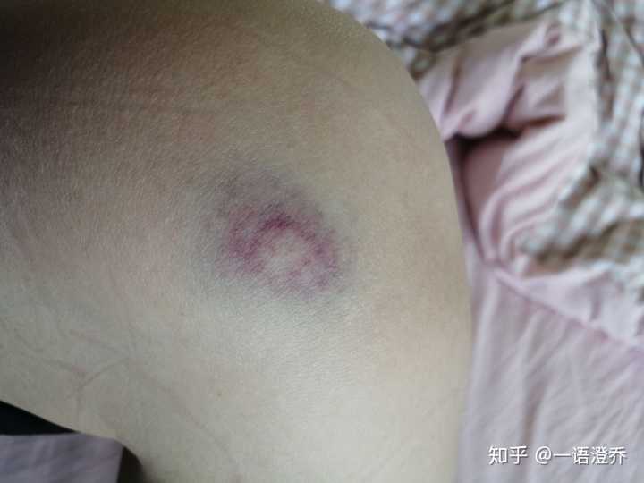 我轻微贫血,在家又吃不好饭(我妈不做,我自己也不想做的时候就饿一顿