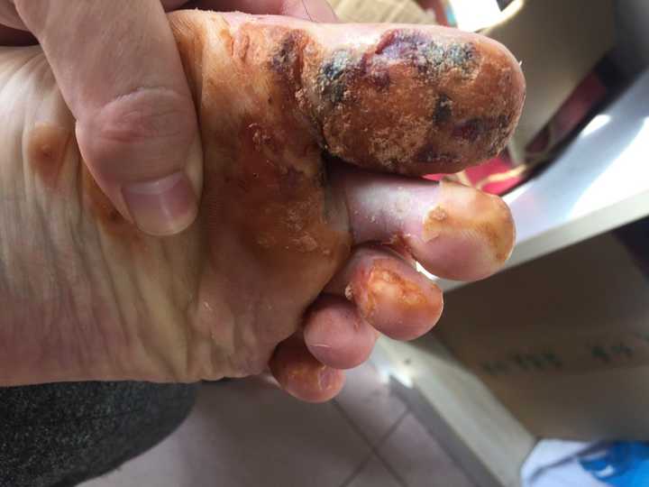 跖疣如何治疗?