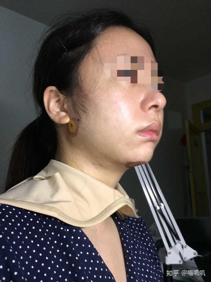 双下巴非常严重 怎么办?