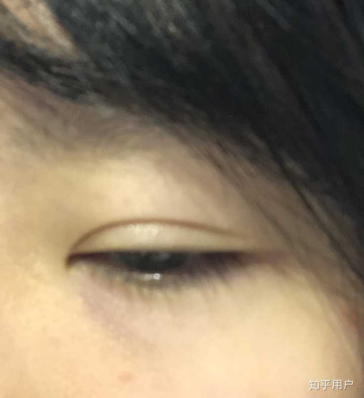 割双眼皮十年后会怎样?