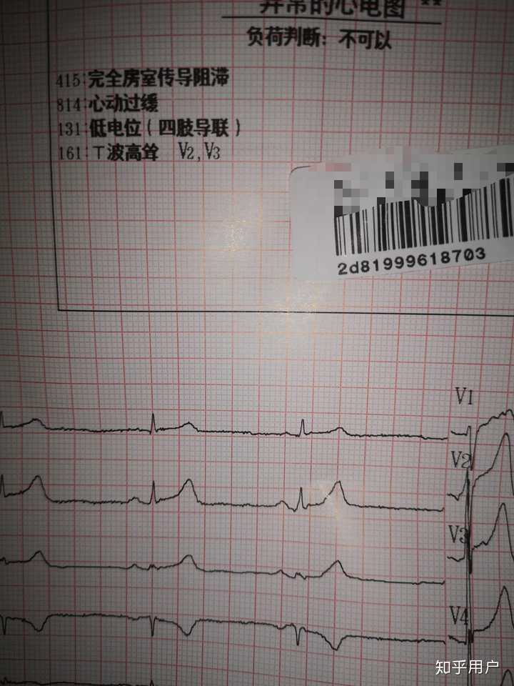 体检被诊断为一度房室传导阻滞是怎样的体验?