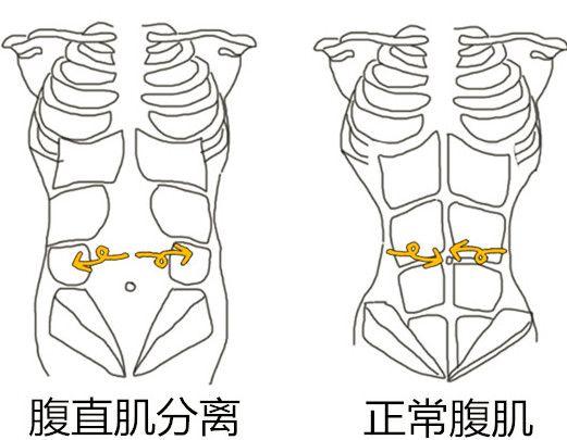 先来了解下腹直肌的位置:腹直肌是在肚子前第5~7肋骨间,止于趾骨.