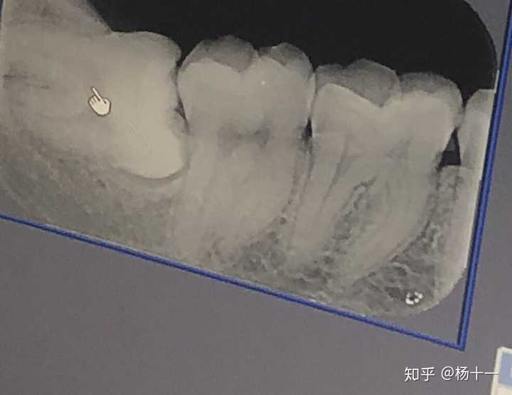 已经可以看到旁边的牙齿已经被智齿挤歪了 如果这样是一定要拔掉的那