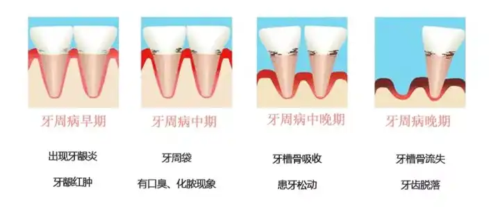 牙龈炎和牙周炎有什么区别?