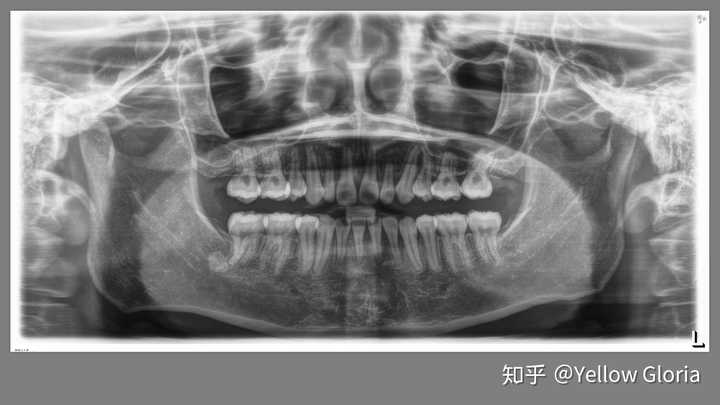 牙周炎已经牙龈萎缩,牙槽骨吸收,怎么办?