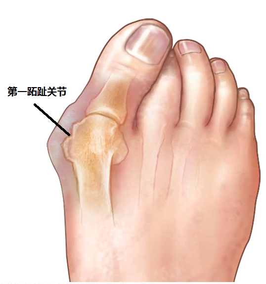 大脚趾关节":典型症状表现为突然发作的第一跖趾关节红肿热痛,疼痛