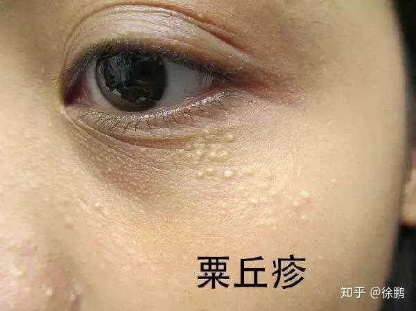 粟丘疹和汗管瘤这两种
