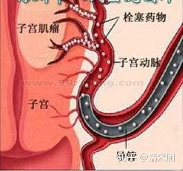 导管子宫动脉栓塞术