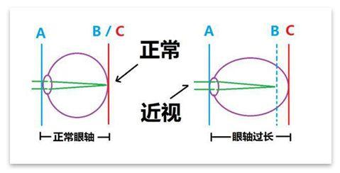 图为正常眼与近视眼眼轴及成像示意图,b 为眼睛看到的像,c 为