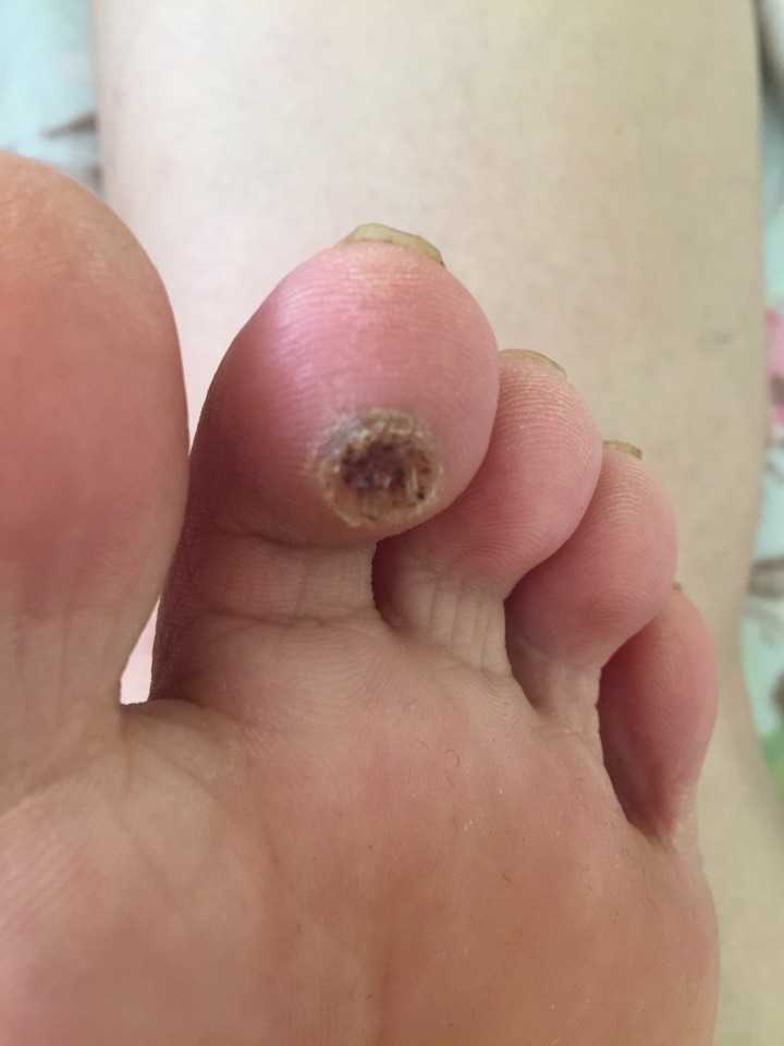 我是大概是2016年9月初发现脚趾下有一个小水泡,硬硬的,走路有点疼