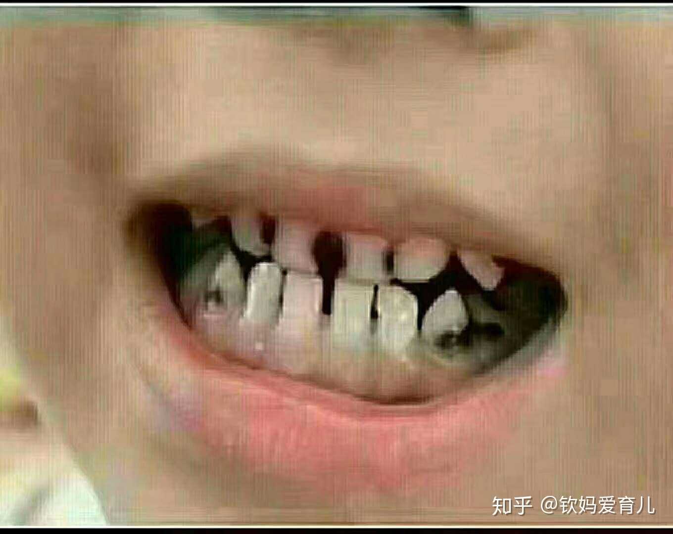 几乎所有的家长都回答的是,孩子爱吃糖,爱含饭,不好好刷牙…… 当我问