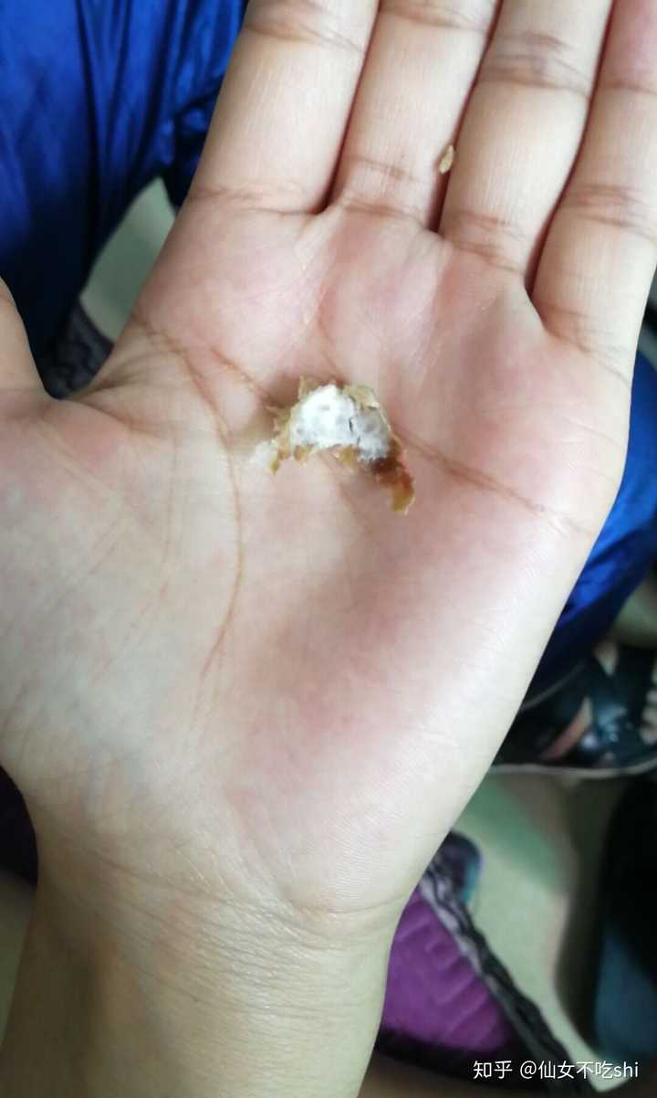 耳屎能大到什么程度?