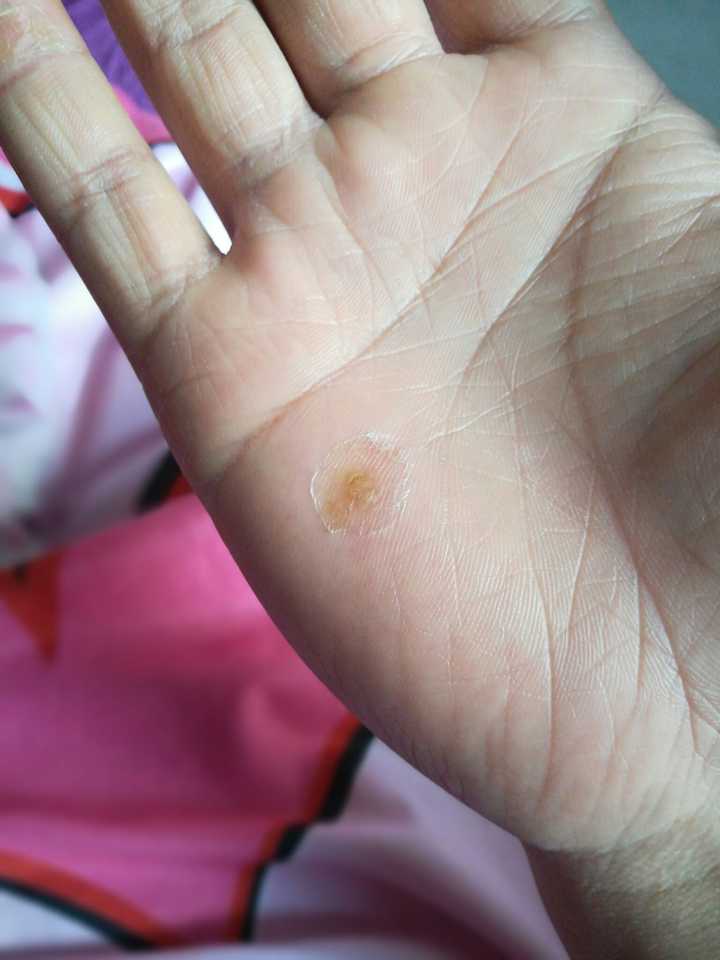 瘊,鸡眼,疣有什么有效的治疗方法?