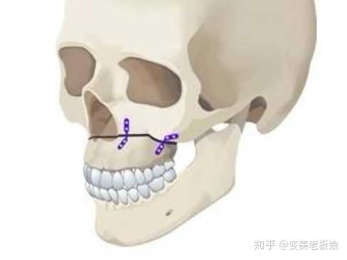 正颌双颌手术对上颌前突下巴后缩有多大的改善?