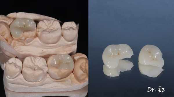 瓷嵌体和树脂补牙齿的区别