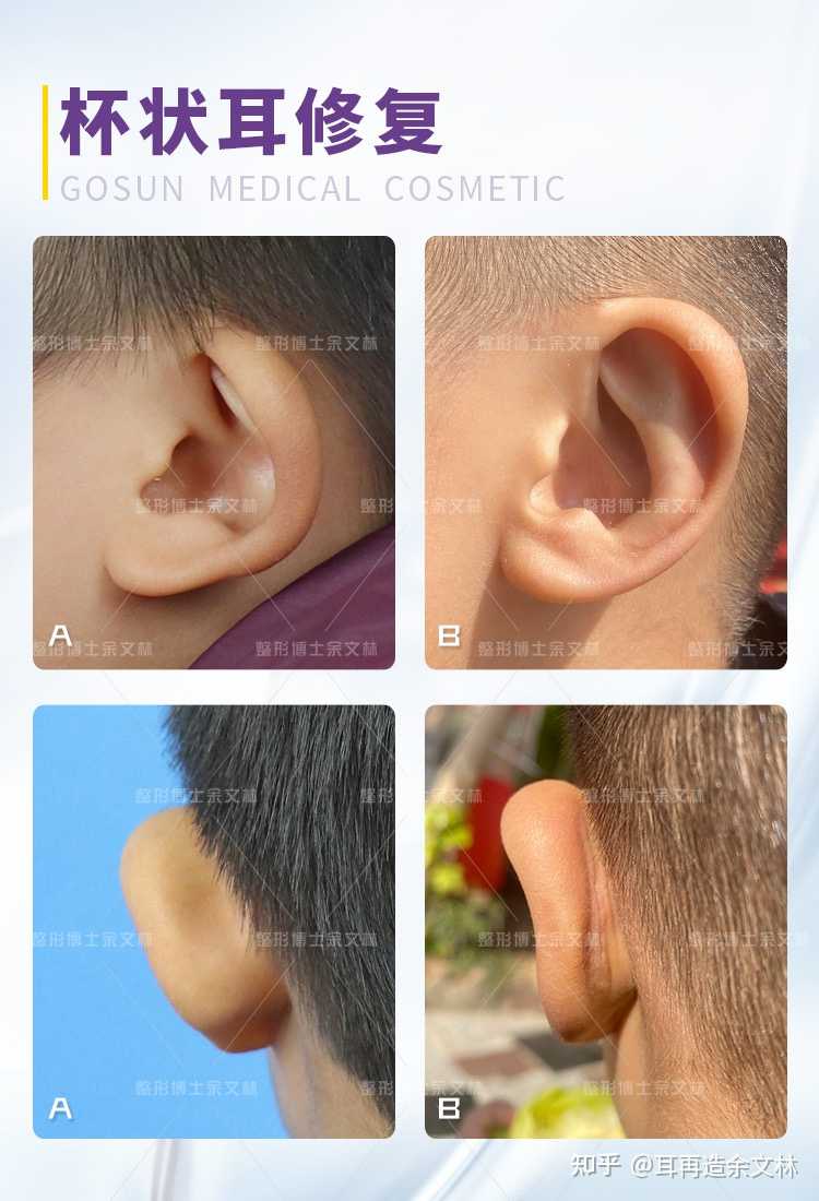 杯状耳,卷曲耳 案例分享