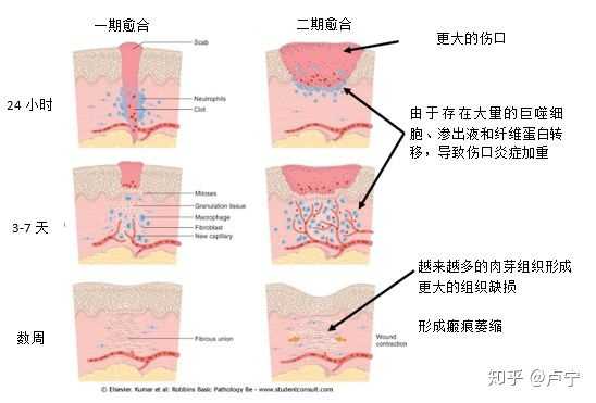 为什么有的伤疤愈合后凸起,有的伤疤愈合后凹陷?