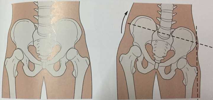 患者骨盆正位片发现 骨盆存在着侧倾/旋转情况.