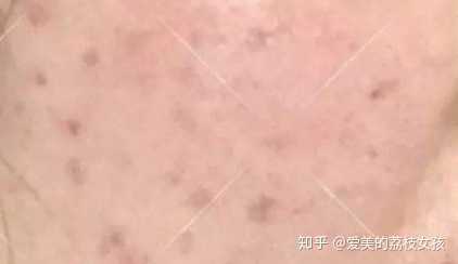 特点:褐(黑)色的pih(pih是指我们皮肤测试的数值),即炎症后色素沉着