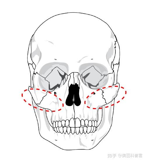先看一下颧骨颧弓的位置,这两块骨头占据了脸中部的大部分体积