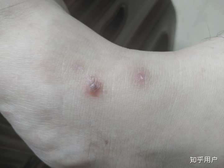 被蚊子咬你们用什么药膏