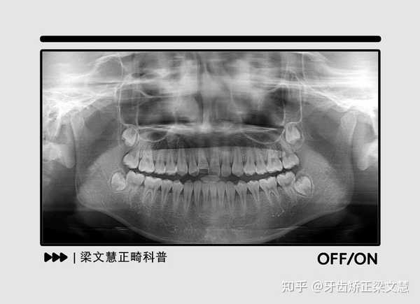 牙根吸收