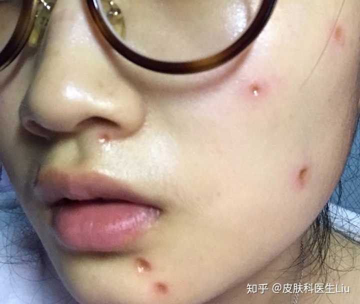 不用买什么药膏,生长因子,纯属多此一举; ——术后注意防晒,不吃可乐