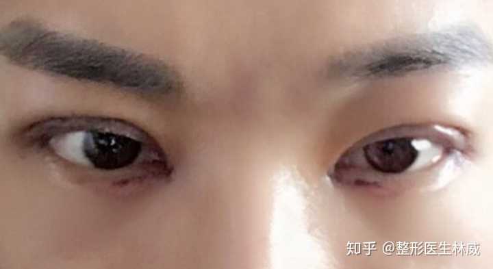男生做双眼皮整形一定要自己考虑清楚,充分做好心理建设和对术后