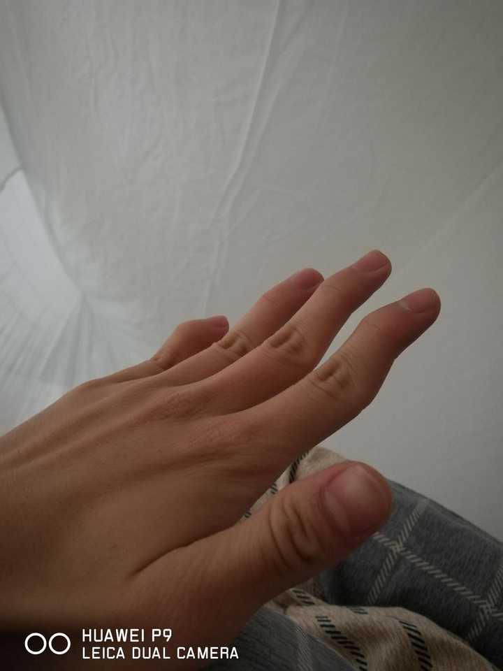 我的手指也是弯的,有时候不敢在人面前伸出手,而且右手是六指(被切了)