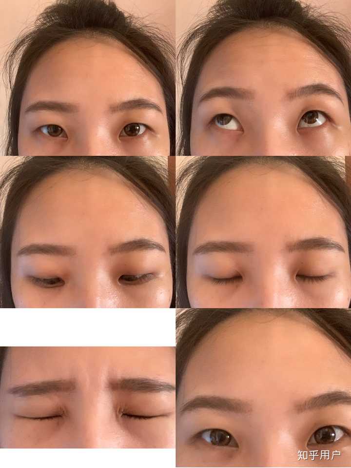 割双眼皮是一种什么样的体验?