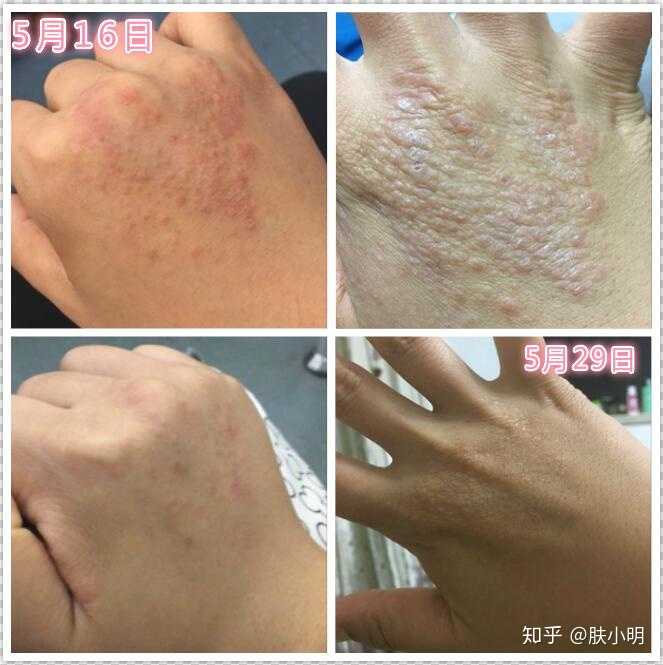 湿疹痊愈后的疤痕/色素印如何去除?