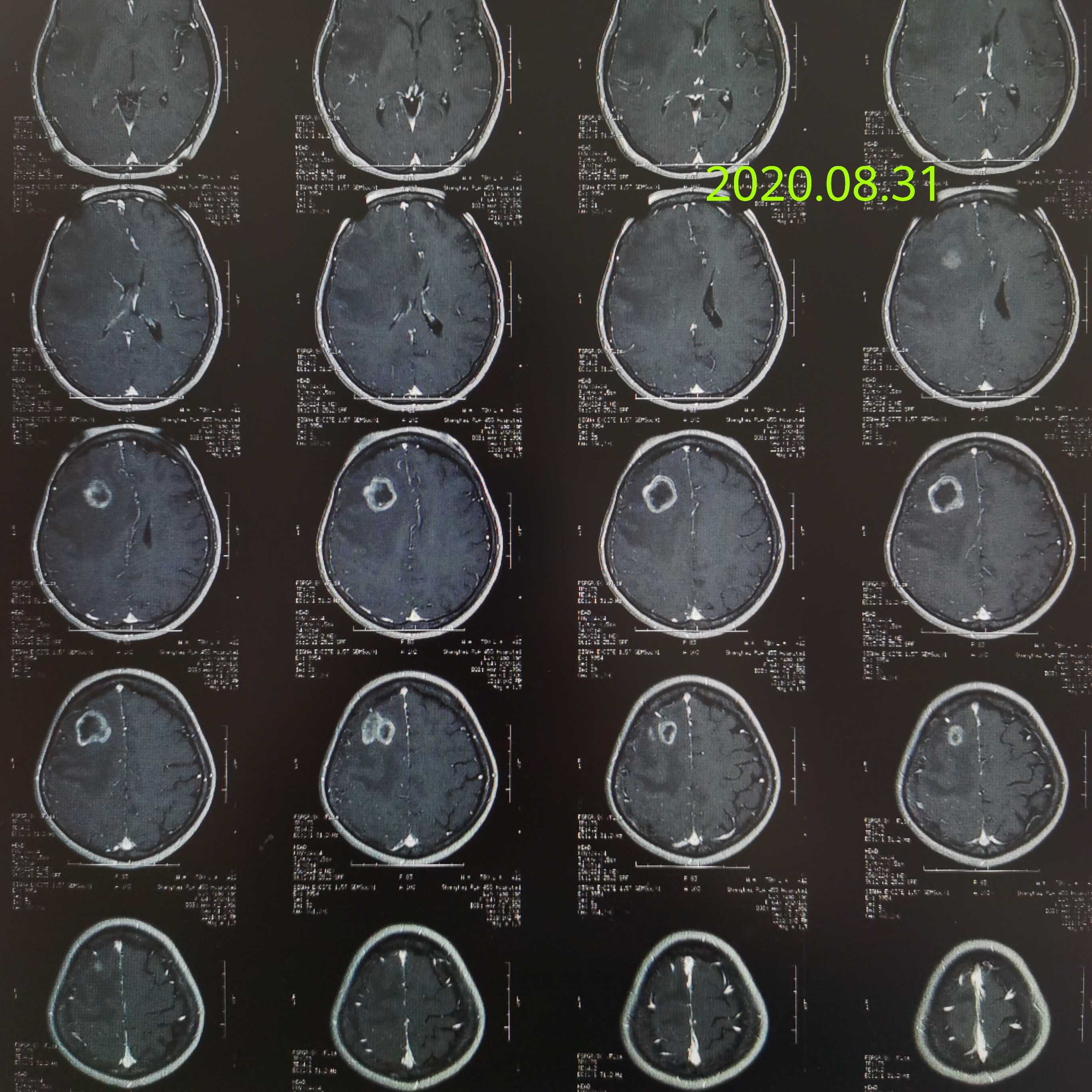 很多患者很多医生认为放疗会造成脑水肿